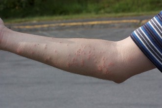 Симптомы укуса постельного клопа у детей и взрослых